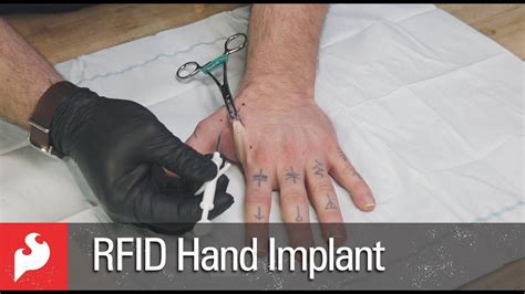 implantation rfid chip|rfid implants before and after.